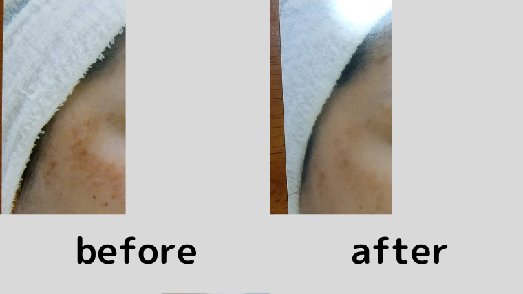 エンビロン使う前と使った後の顔のシミの改善具合